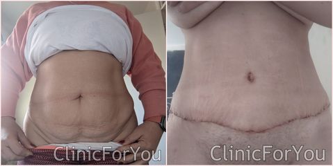 Plastyka brzucha - ClinicForYou
