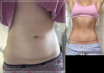 Plastyka brzucha - ClinicForYou