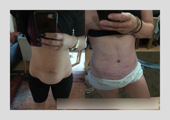 Plastyka brzucha - ClinicForYou