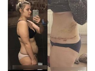 Plastyka brzucha - ClinicForYou