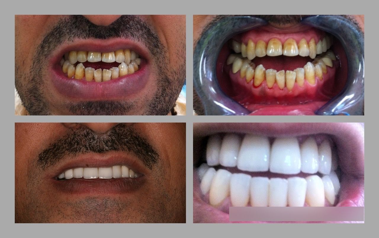 Implanty zębowe Przed i po Estheticon pl Estheticon pl