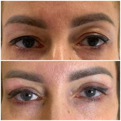 Blefaroplastyka - Nuova Estetica