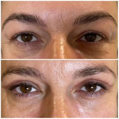 Blefaroplastyka - Nuova Estetica