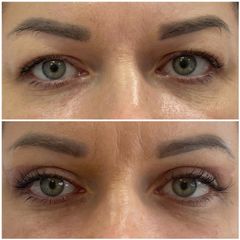 Blefaroplastyka - Nuova Estetica