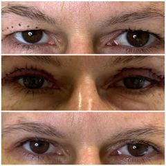 Blefaroplastyka - Nuova Estetica