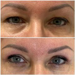 Blefaroplastyka - Nuova Estetica