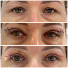 Blefaroplastyka - Nuova Estetica