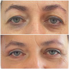 Blefaroplastyka - Nuova Estetica