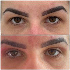 Blefaroplastyka - Nuova Estetica