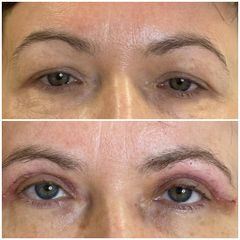 Blefaroplastyka - Nuova Estetica