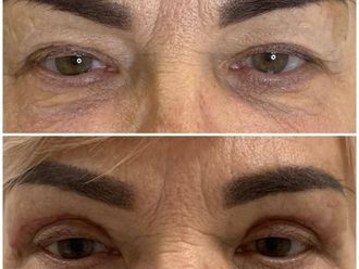 Blefaroplastyka przed i po - 868300