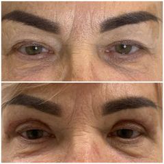 Blefaroplastyka - Nuova Estetica