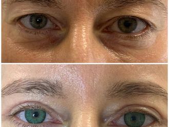 Blefaroplastyka przed i po - 868301