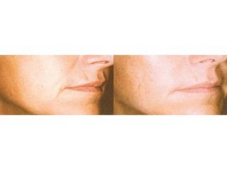 Przed i po - Sculptra - kwas polimlekowy