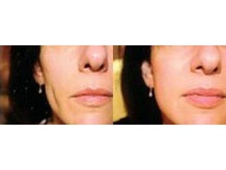 Przed i po - wypełnianie bruzd nosowo-wargowych kwasem hialuronowym