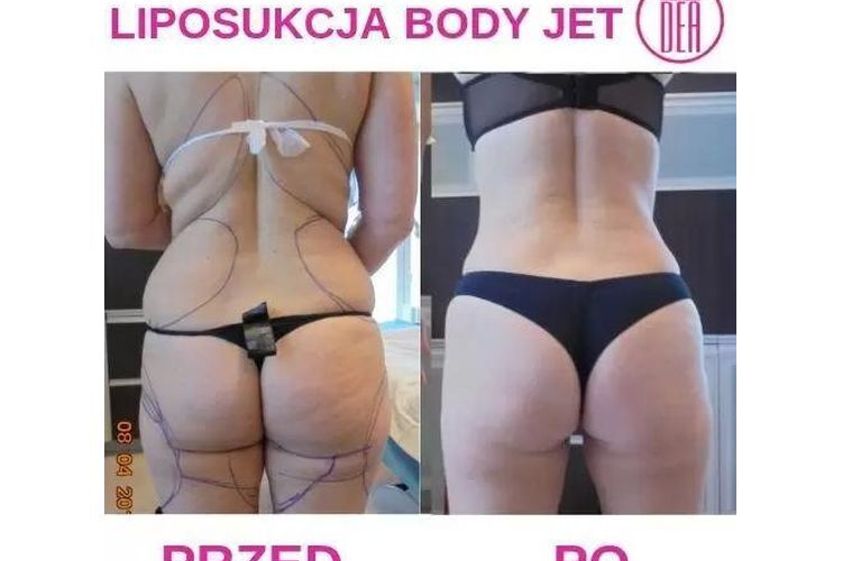 Liposukcja wodna przed i po - 686966