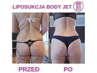 Przed i po - liposukcja wodna