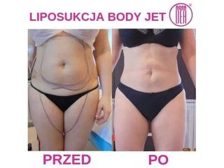 Przed i po - liposukcja wodna