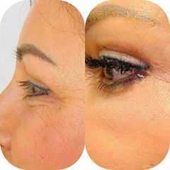 Blefaroplastyka powiek dolnych 