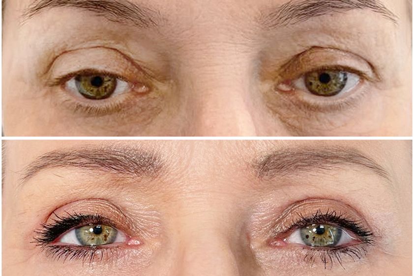 Blefaroplastyka przed i po - 840651