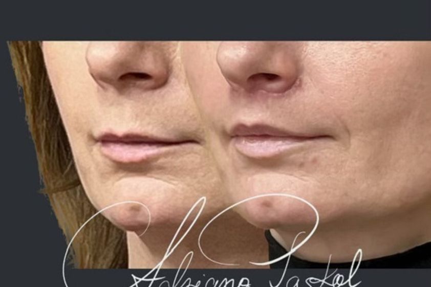 Lip Lift przed i po - 847864