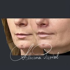 Lip lift - dr n. med. Adriana Paskal