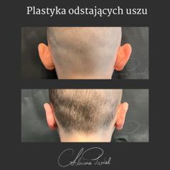 Korekcja uszu - dr n. med. Adriana Paskal