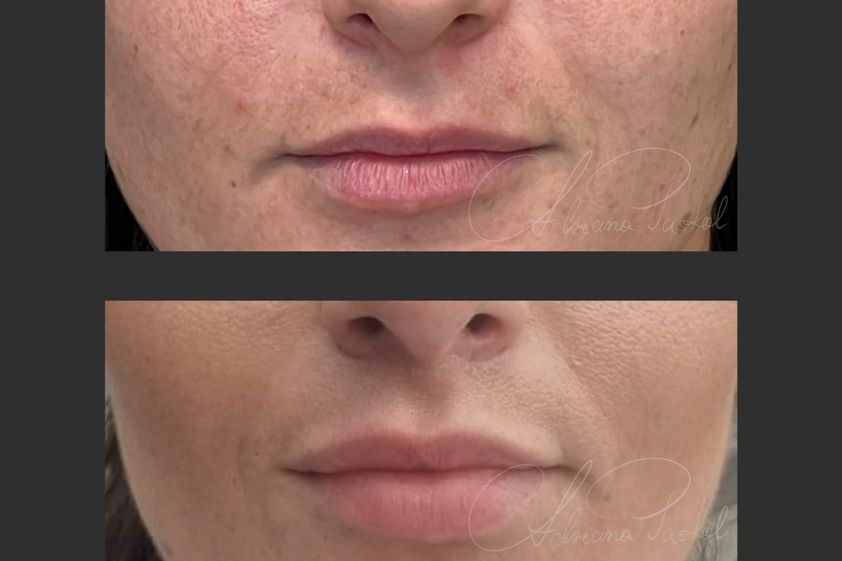 Lip Lift przed i po - 855214