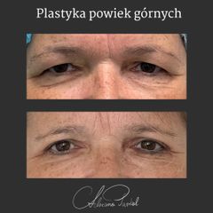 Plastyka powiek - dr n. med. Adriana Paskal
