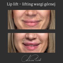 Lip lift - dr n. med. Adriana Paskal