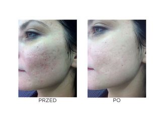Leczenie trądziku - efekty