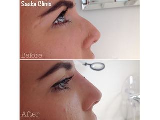 Korekta garbka nosa kwasem hialuronowym - efekty