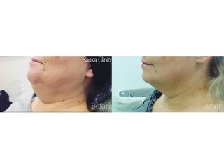 Lipoliza iniekcyjna podbródka - efekty