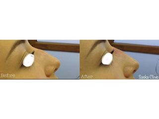 Korekta garbka nosa kwasem hialuronowym - efekty