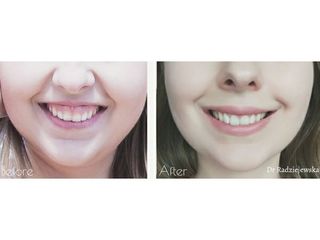 Korekta uśmiechu dziąsłowego