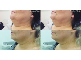 Lipoliza iniekcyjna podbródka - efekty