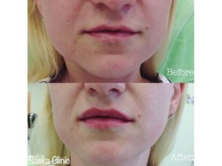 Powiększanie ust - efekty