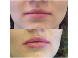 Powiększanie ust - efekty