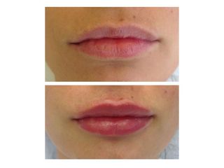 Powiększanie ust - efekty