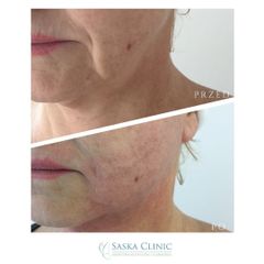 Endolift laserowy - przed i po