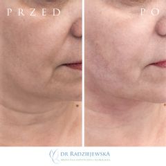 Endolift laserowy - przed i po