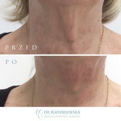 Endolift laserowy - przed i po