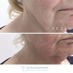 Endolift laserowy - przed i po