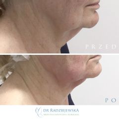 Endolift laserowy - przed i po