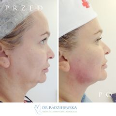 Endolift laserowy - przed i po