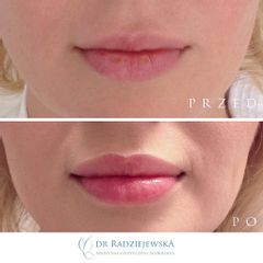 Powiększanie ust - efekty