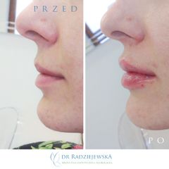 Powiększanie ust - efekty