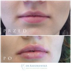 Powiększanie ust - efekty