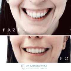 Korekcja uśmiechu dziąsłowego toksyną botulinową - efekty