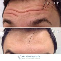 Korekcja bruzd toksyną botulinową - efekty